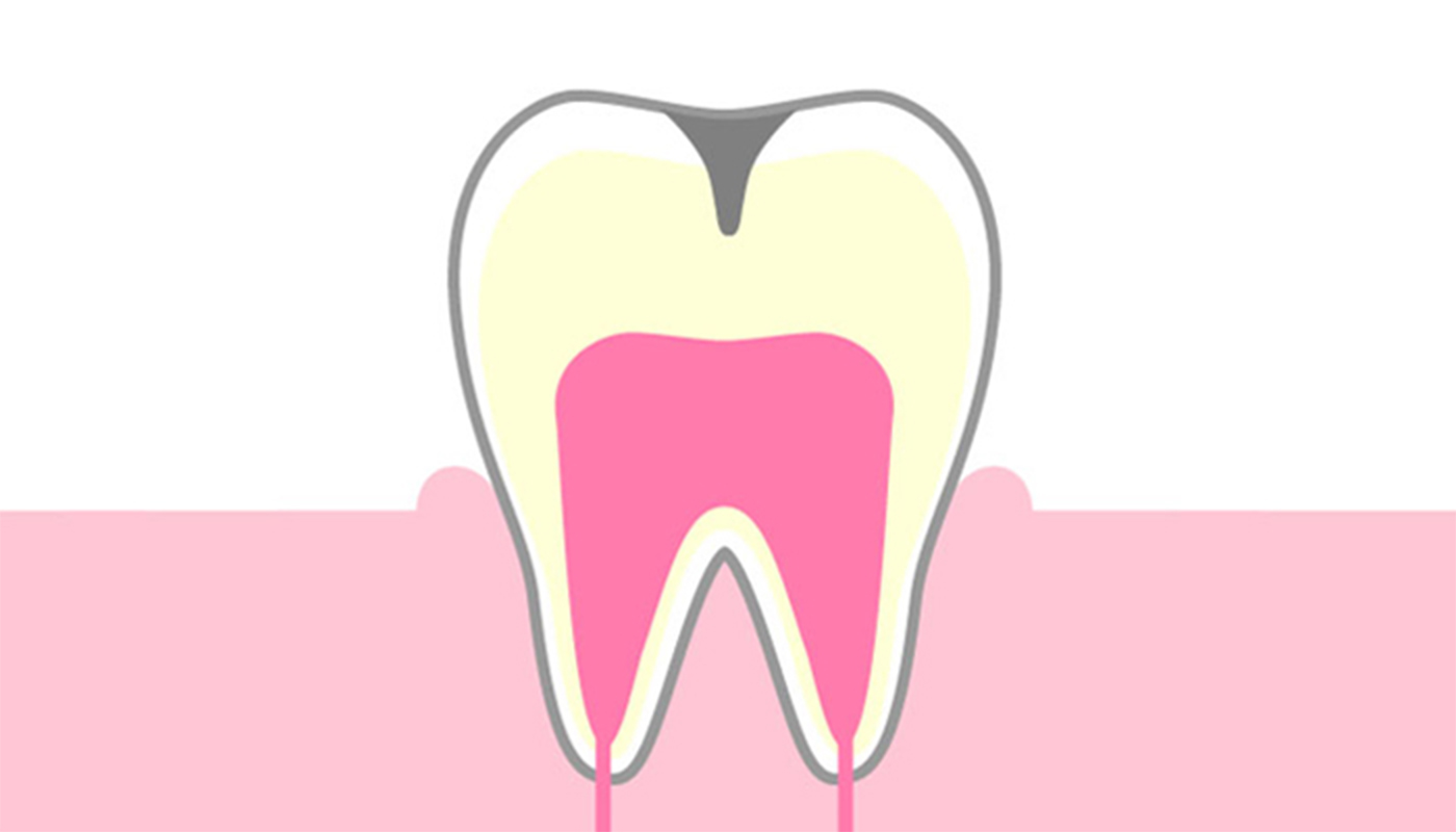 象牙質に達したむし歯