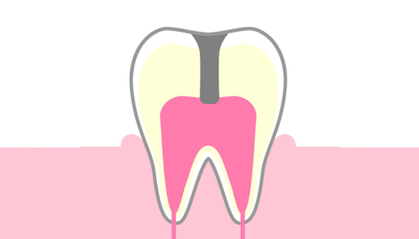 歯髄（神経)に達したむし歯