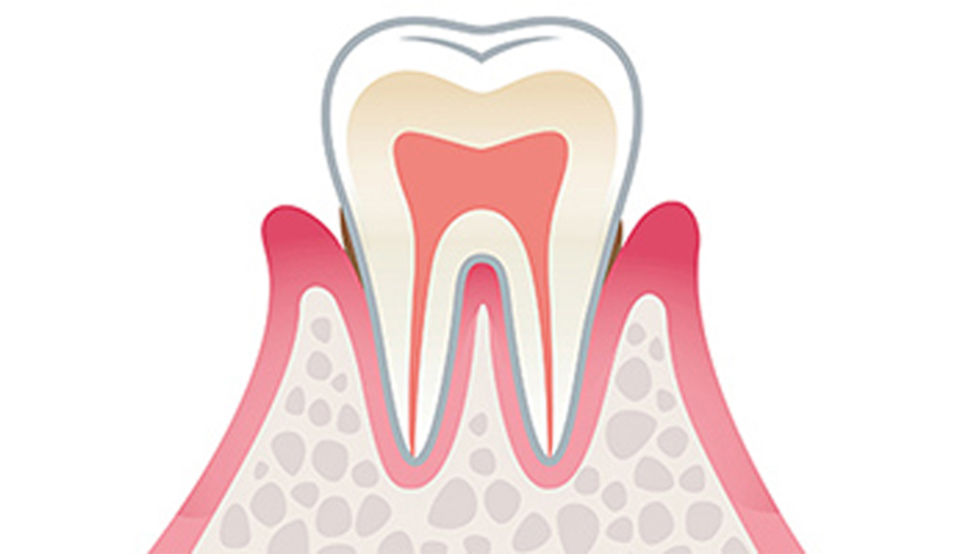 軽度歯周炎